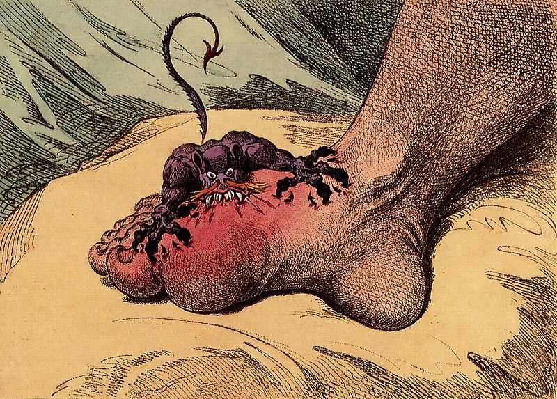 Gout, a 1799 caricature by James Gillray.