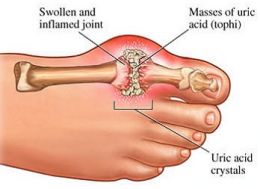 Gout Care Diagram